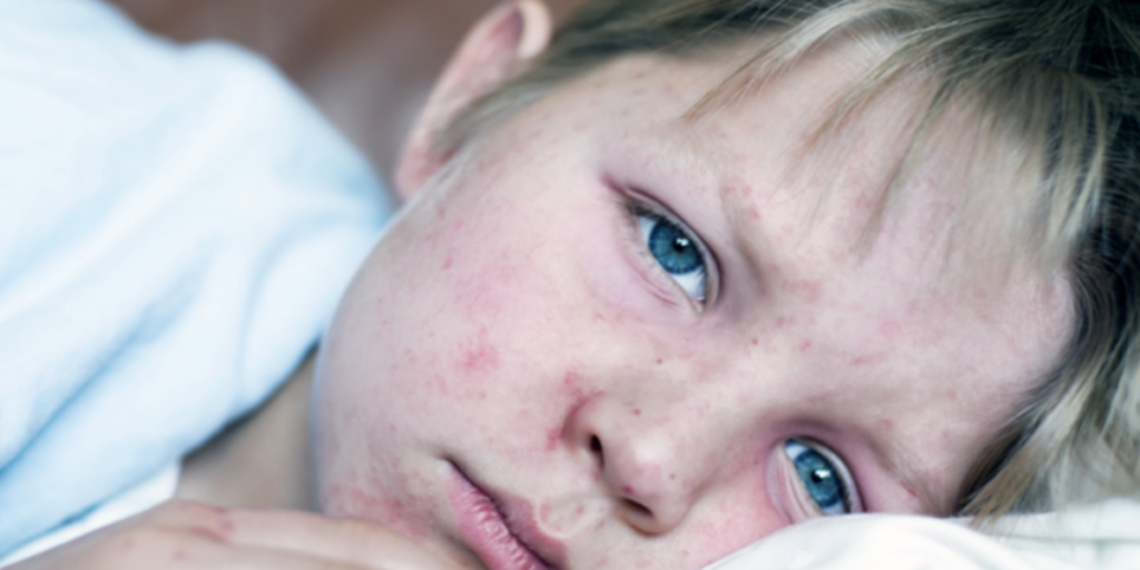 La vaccination contre la rougeole :           Protégez-vous et votre entourage